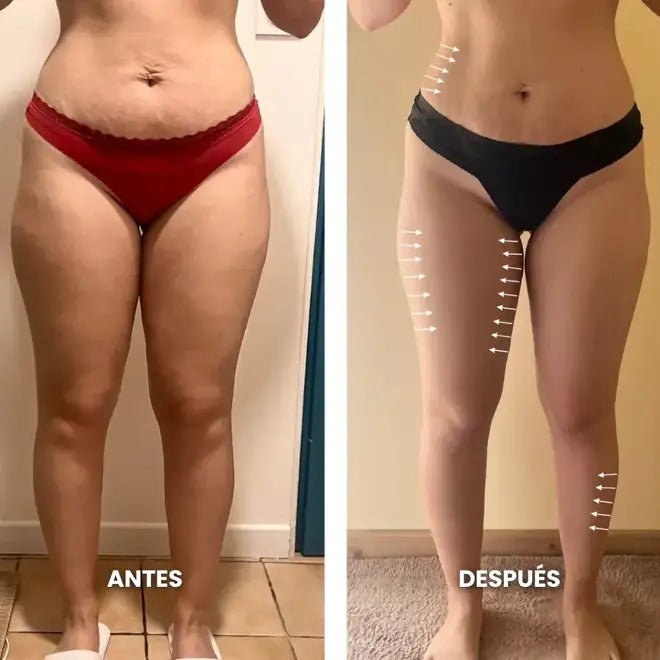 Antes y después: abdomen y muslos