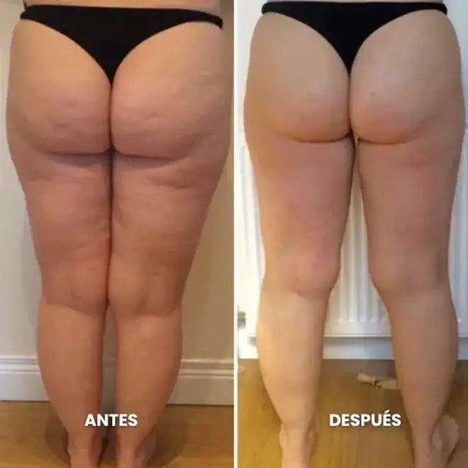 Antes y después: Muslos